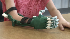 person wearing 3d printed hand prosthetic